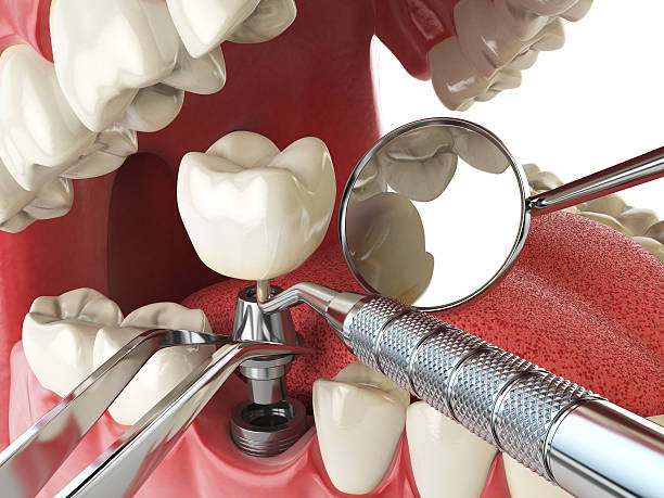 Best Emergency Tooth Extraction in Covington, GA